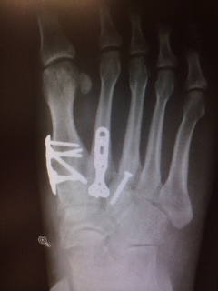 Mr Pal Ramesh, Consultant Orthopaedic Foot & Ankle Surgeon